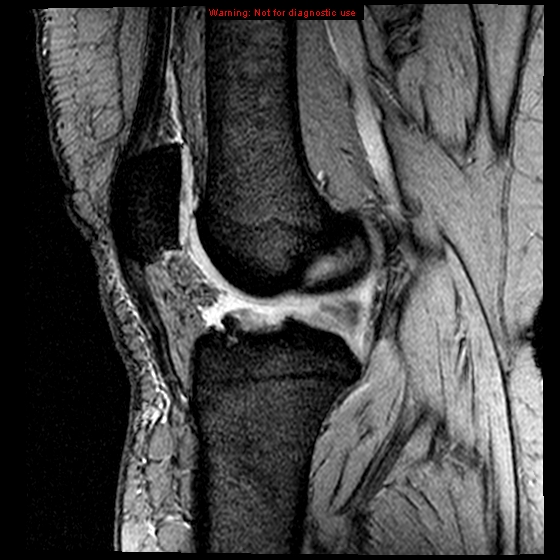 File:Anterior cruciate ligament tear (Radiopaedia 12329-12612 A 10).jpg