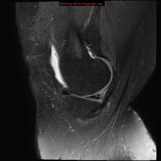 File:Anterior cruciate ligament tear - complete (Radiopaedia 12175-12514 Sagittal T2 fat sat 17).jpg