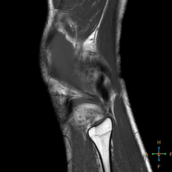 File:Anterior cruciate ligament tear - complete (Radiopaedia 24907-25170 Sagittal T1 1).jpg