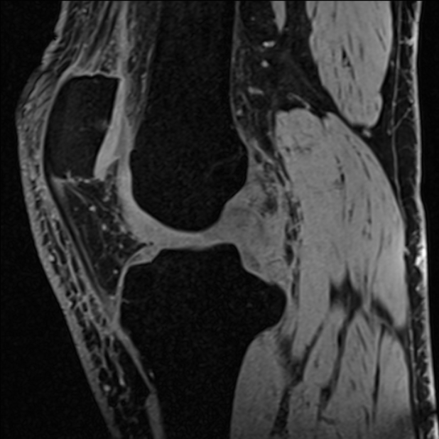 Anterior cruciate ligament tear - ramp lesion (Radiopaedia 71883-82322 Sagittal T1 vibe 80).jpg