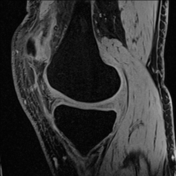 Anterior cruciate ligament tear - ramp lesion (Radiopaedia 71883-82322 Sagittal T1 vibe 94).jpg