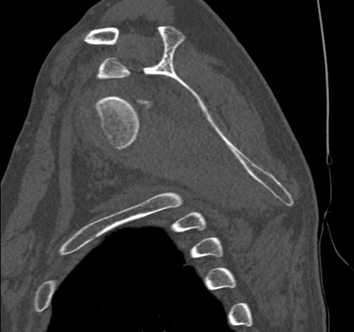 Anterior glenohumeral dislocation with Hill-Sachs lesion (Radiopaedia 62877-71249 Sagittal bone window 40).jpg