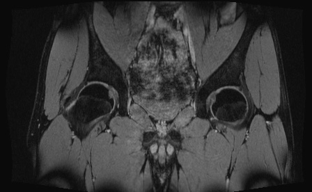 Anterior inferior iliac spine avulsion fracture (Radiopaedia 81312-95000 G 50).jpg