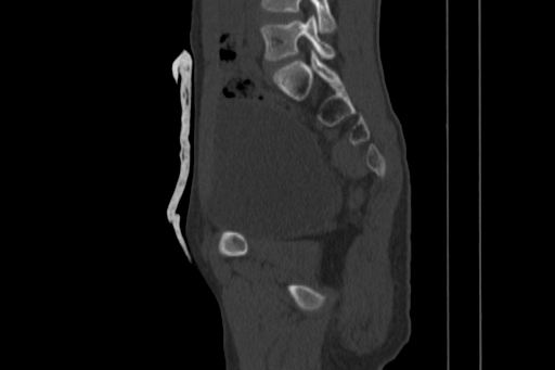 Anterior inferior iliac spine avulsion injury (Radiopaedia 88666-105376 Sagittal bone window 43).jpg