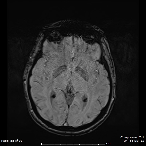 File:Anterior temporal lobe perivascular space (Radiopaedia 88283-104914 Axial SWI 24).jpg