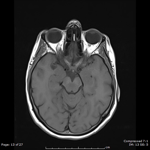 File:Anterior temporal lobe perivascular space (Radiopaedia 88283-104914 Axial T1 13).jpg