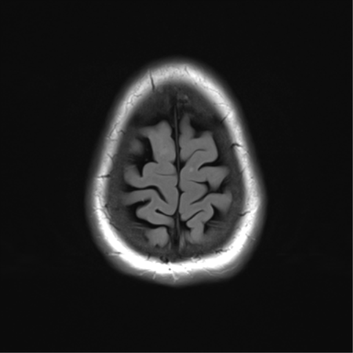 File:Anterior temporal pole cysts (Radiopaedia 46629-51102 Axial FLAIR 25).png