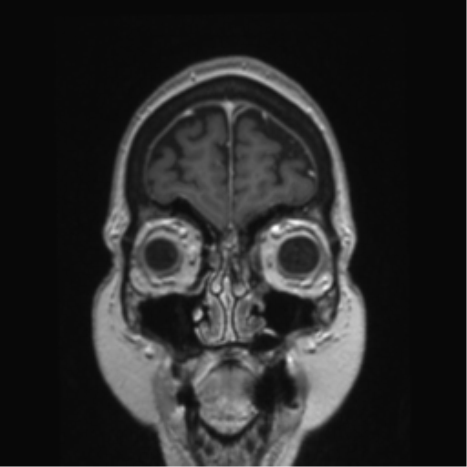Anterior temporal pole cysts (Radiopaedia 46629-51102 Coronal T1 C+ 152).png