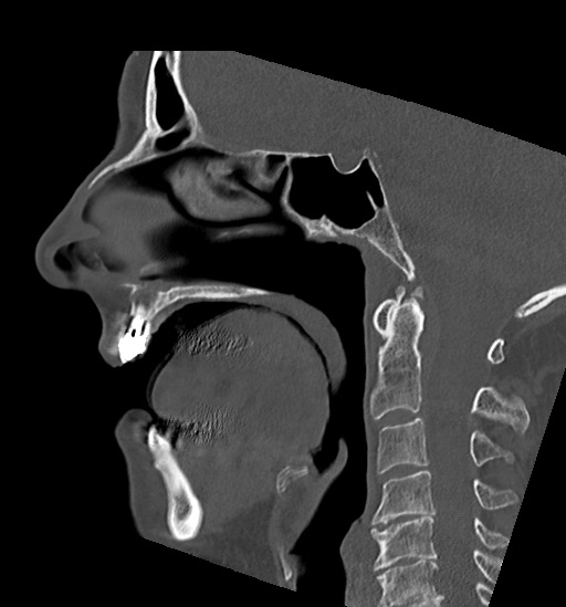 Anterior temporomandibular joint dislocation (Radiopaedia 59430-66784 B 30).jpg