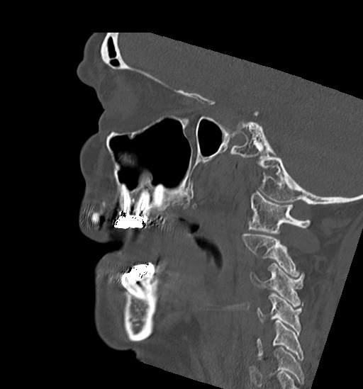 Anterior temporomandibular joint dislocation (Radiopaedia 59430-66784 B 41).jpg