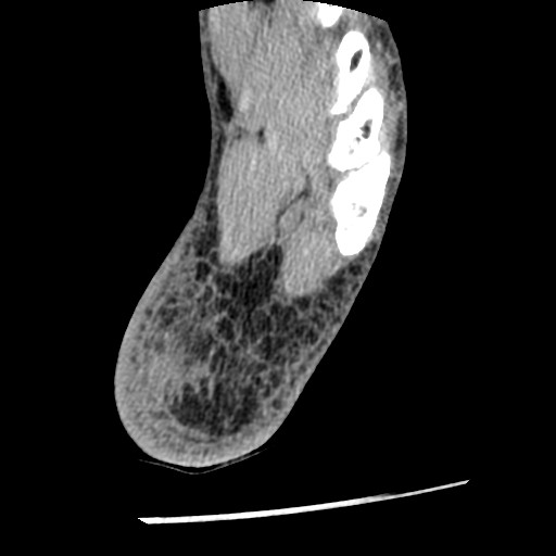 Anterior tibial artery false aneurysm (Radiopaedia 88984-105809 A 233).jpg