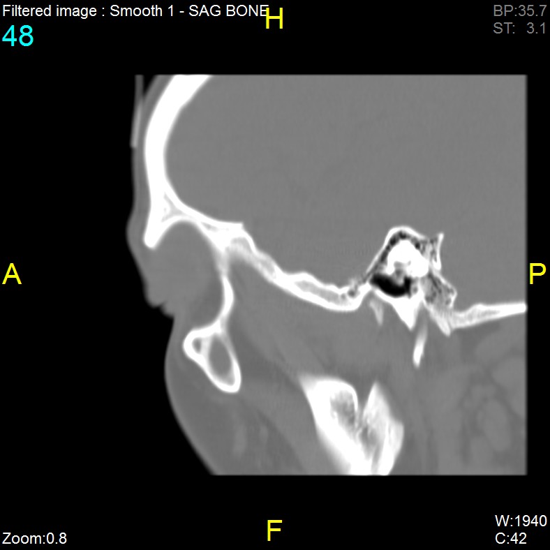 Antrochoanal polyp (Radiopaedia 65101-74094 Sagittal bone window 48).jpg