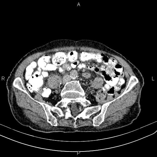 File:Aortic aneurysm and Lemmel syndrome (Radiopaedia 86499-102554 Axial C+ delayed 53).jpg
