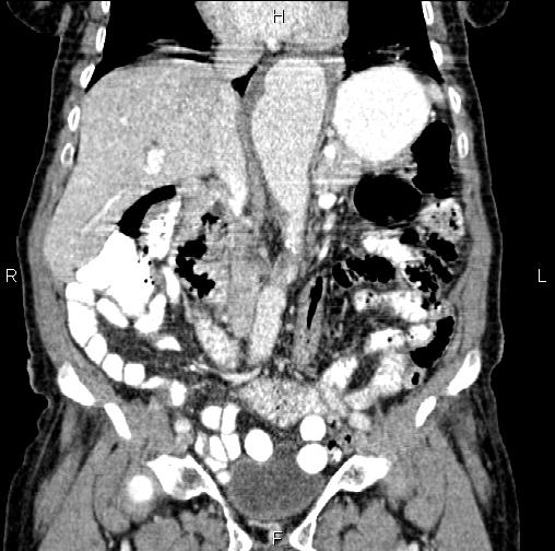 File:Aortic aneurysm and Lemmel syndrome (Radiopaedia 86499-102554 C 27).jpg
