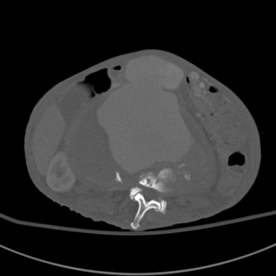 Aortic aneurysm with spinal destruction (Radiopaedia 42301-45410 Axial bone window 47).jpg