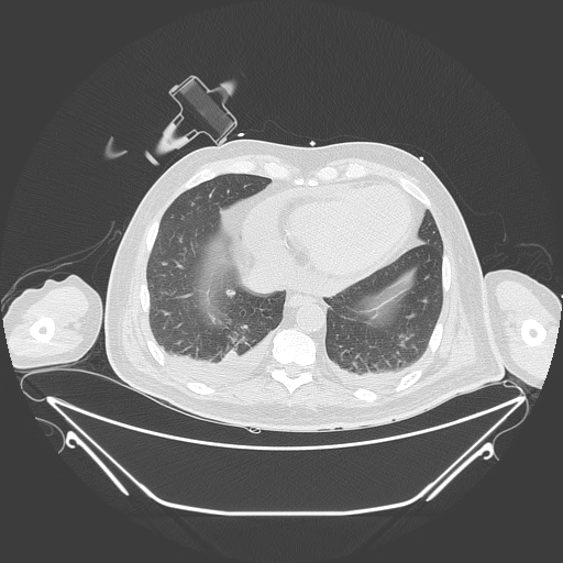 Aortic arch aneurysm (Radiopaedia 84109-99365 Axial lung window 212).jpg