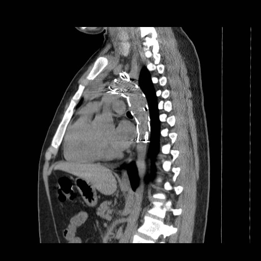 File:Aortic arch stent (Radiopaedia 30030-30595 B 14).jpg