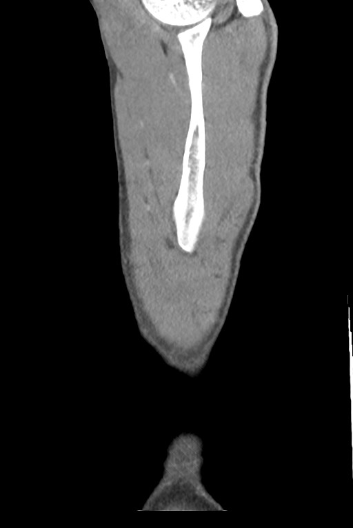 Aortic coarctation with aneurysm (Radiopaedia 74818-85828 B 156).jpg