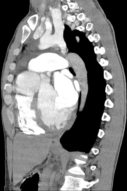 Aortic coarctation with aneurysm (Radiopaedia 74818-85828 B 95).jpg