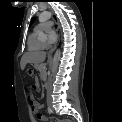 File:Aortic dissection- Stanford A (Radiopaedia 37759-39664 Sagittal C+ delayed 16).png