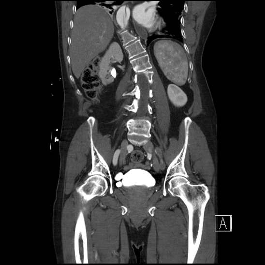 File:Aortic dissection (CTPA) (Radiopaedia 75506-86750 F 46).jpg