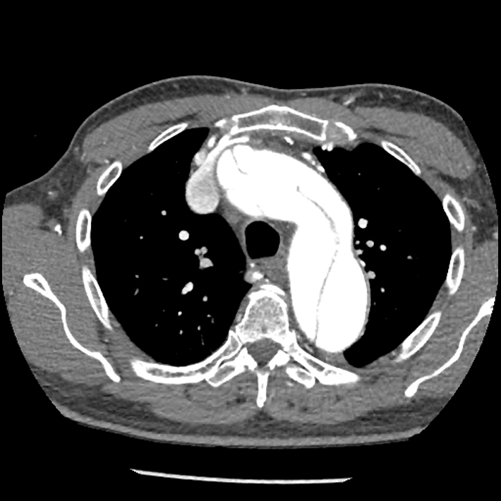 Aortic dissection - DeBakey Type I-Stanford A (Radiopaedia 79863-93115 A 10).jpg