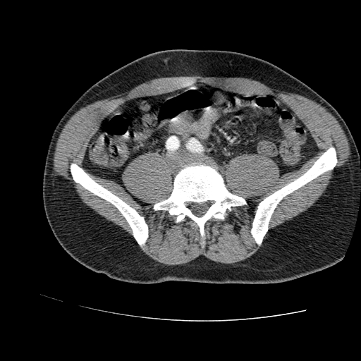 File:Aortic dissection - Stanford A -DeBakey I (Radiopaedia 28339-28587 B 169).jpg