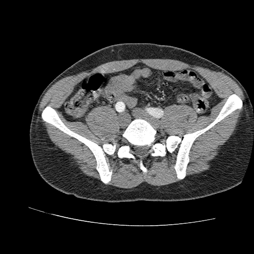 File:Aortic dissection - Stanford A -DeBakey I (Radiopaedia 28339-28587 B 175).jpg