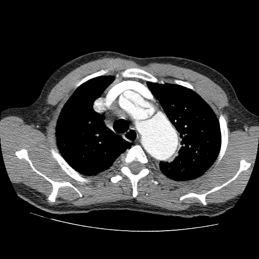 File:Aortic dissection - Stanford A -DeBakey I (Radiopaedia 28339-28587 B 7).jpg