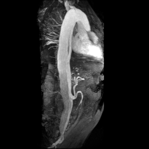 File:Aortic dissection - Stanford A - DeBakey I (Radiopaedia 23469-23551 MRA 6).jpg