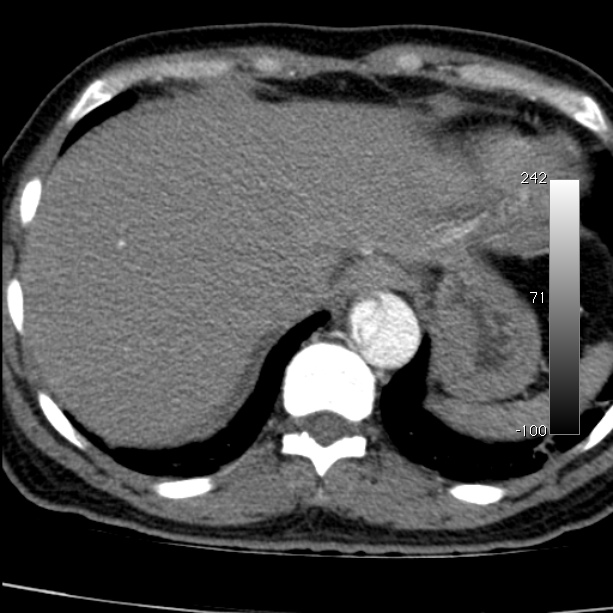 Aortic dissection - Stanford type A (Radiopaedia 29247-29659 A 65).jpg