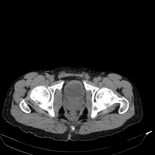 Aortic dissection - Stanford type A (Radiopaedia 83418-98500 Axial non-contrast 91).jpg
