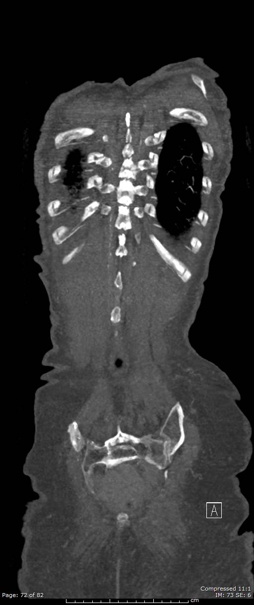 Aortic dissection with extension into aortic arch branches (Radiopaedia 64402-73204 A 72).jpg
