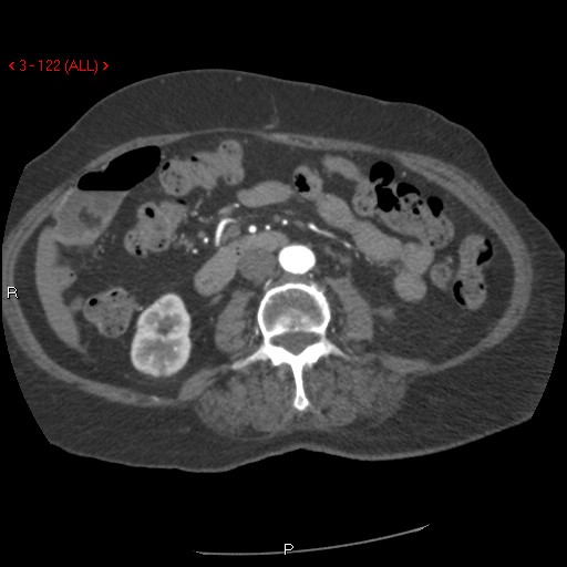 Aortic intramural hematoma (Radiopaedia 27746-28001 A 122).jpg