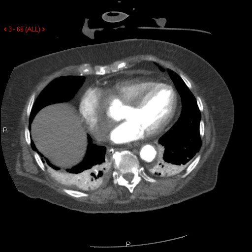 File:Aortic intramural hematoma (Radiopaedia 27746-28001 A 66).jpg