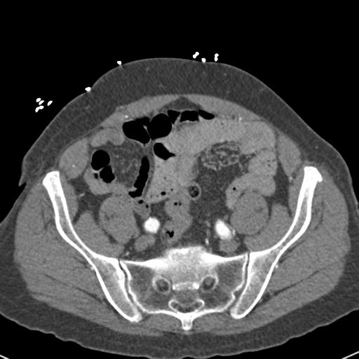 Aortic intramural hematoma (Radiopaedia 31139-31838 B 140).jpg