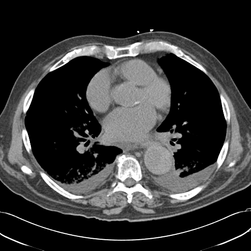 Aortic intramural hematoma (Radiopaedia 34260-35540 Axial non-contrast 37).png