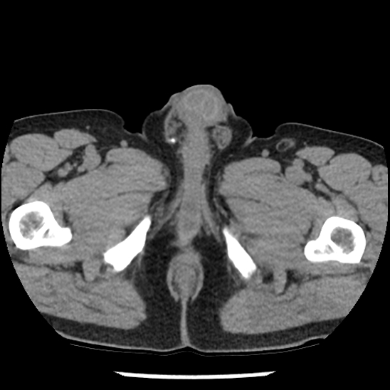 Aortic intramural hematoma (type B) (Radiopaedia 79323-92387 Axial non-contrast 125).jpg
