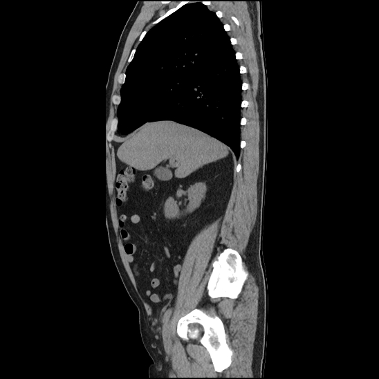 Aortic intramural hematoma (type B) (Radiopaedia 79323-92387 G 12).jpg
