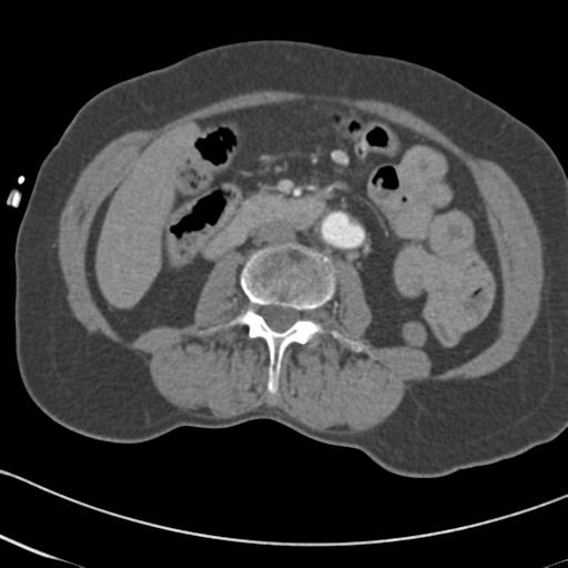 Aortic intramural hematoma from penetrating atherosclerotic ulcer (Radiopaedia 31137-31836 A 111).jpg