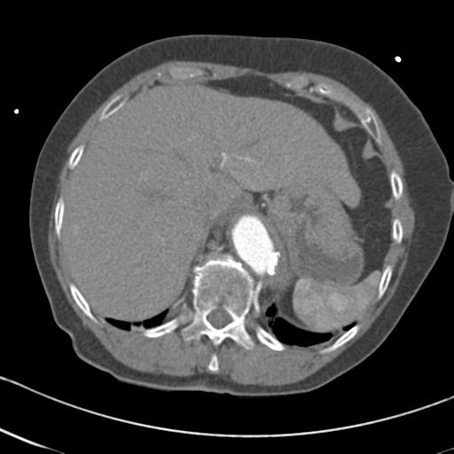 Aortic intramural hematoma from penetrating atherosclerotic ulcer (Radiopaedia 31137-31836 A 71).jpg