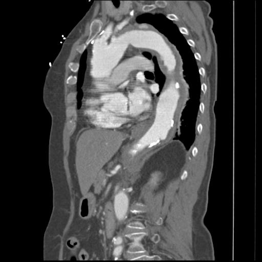 File:Aortic intramural hematoma from penetrating atherosclerotic ulcer (Radiopaedia 31137-31836 B 15).jpg
