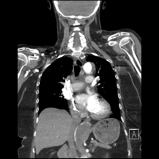 File:Aortic intramural hematoma with dissection and intramural blood pool (Radiopaedia 77373-89491 C 31).jpg