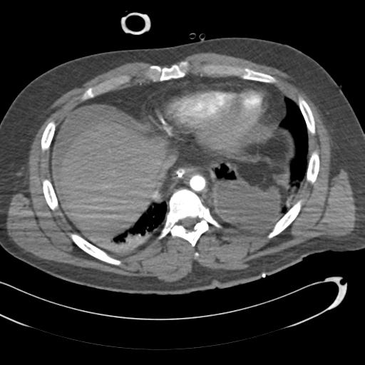 Aortic transection, diaphragmatic rupture and hemoperitoneum in a complex multitrauma patient (Radiopaedia 31701-32622 A 64).jpg