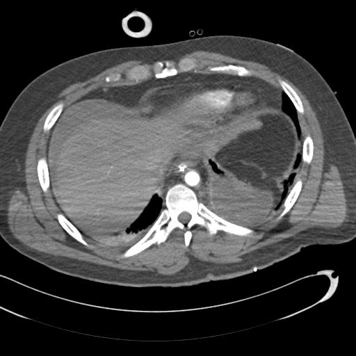 Aortic transection, diaphragmatic rupture and hemoperitoneum in a complex multitrauma patient (Radiopaedia 31701-32622 A 67).jpg
