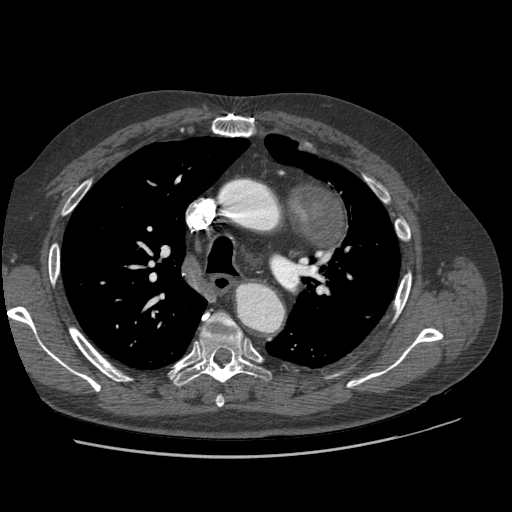 File:Aorto-coronary bypass graft aneurysms (Radiopaedia 40562-43157 A 38).png
