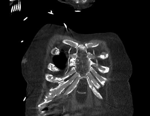 Aortoesophageal fistula with endovascular repair (Radiopaedia 73781-84592 Coronal C+ CTPA 1).jpg