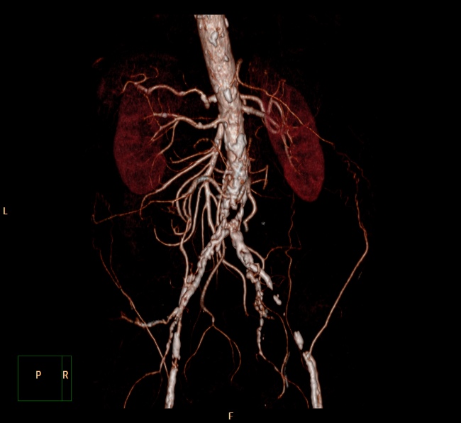 File:Aortoiliac occlusive disease (Radiopaedia 32134-33076 VR C+ arterial phase 8).jpg