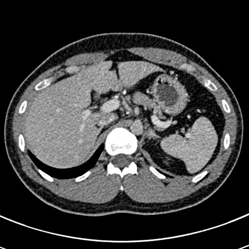 Apical lung mass mimic - neurogenic tumor (Radiopaedia 59918-67521 A 83).jpg