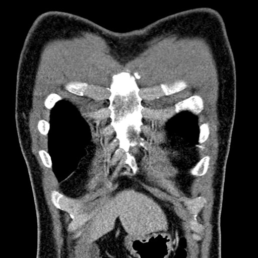 Apical lung mass mimic - neurogenic tumor (Radiopaedia 59918-67521 B 36).jpg